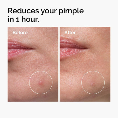 The Ordinary Oil Control Duo, Blemish Skin Care Set, Niacinamide 10% + Zinc 1% and Sulfur 10% Powder-To-Cream Concentrate