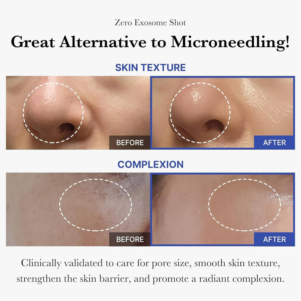 medicube Exosome Shot Zero 2,000 PPM Spicule Facial Serum For Pores & Sebum
