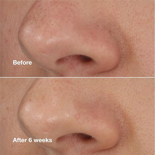 Clinique Blackhead Solutions Self-Heating Blackhead Remover With Salicylic Acid For All Skin Types, 0.68 Fl Oz