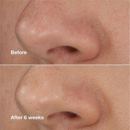 Clinique Blackhead Solutions Self-Heating Blackhead Remover With Salicylic Acid For All Skin Types, 0.68 Fl Oz