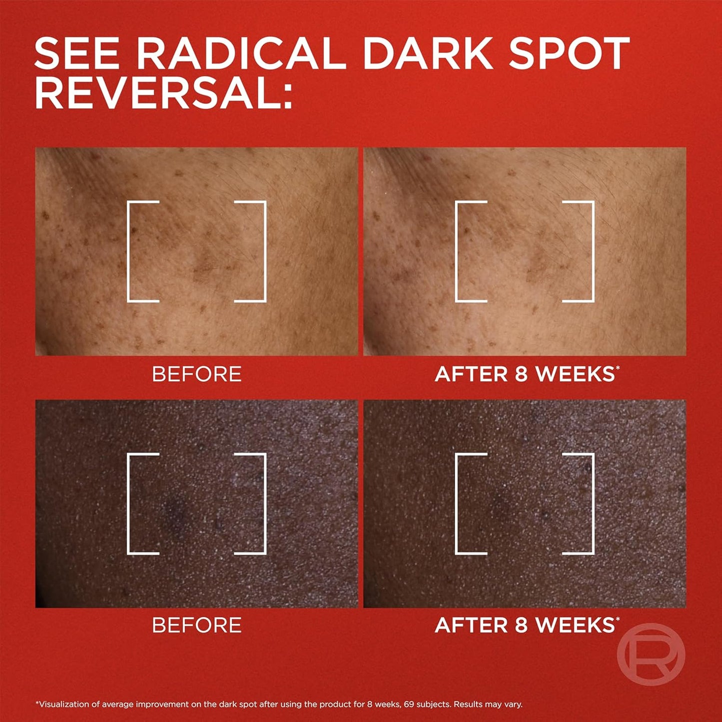 L'Oreal Paris Revitalift Triple Power Dark Spot Corrector Creamy-Serum, Hyperpigmentation Treatment With Melasyl, Vitamin C & Niacinamide, Treats Sun Spots, Dark Spots, Aging & Uneven Tone, 1.7 fl oz