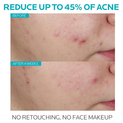 La Roche-Posay Effaclar Salicylic Acid Acne Serum Treatment Pore Minimizer