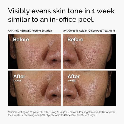 The Ordinary AHA 30% + BHA 2% Peeling Solution, Advanced Exfoliating Peel for Brighter Skin