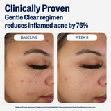 Cetaphil Gentle Clear Mattifying Acne Moisturizer With Salicylic Acid, 3 fl oz