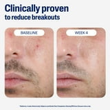 Cetaphil Gentle Clear Complexion-Clearing BPO Acne Cleanser for Sensitive Skin, 4.2 oz
